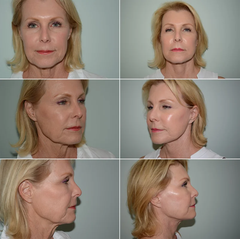 Face lift before and after showing significant facial contour changes.