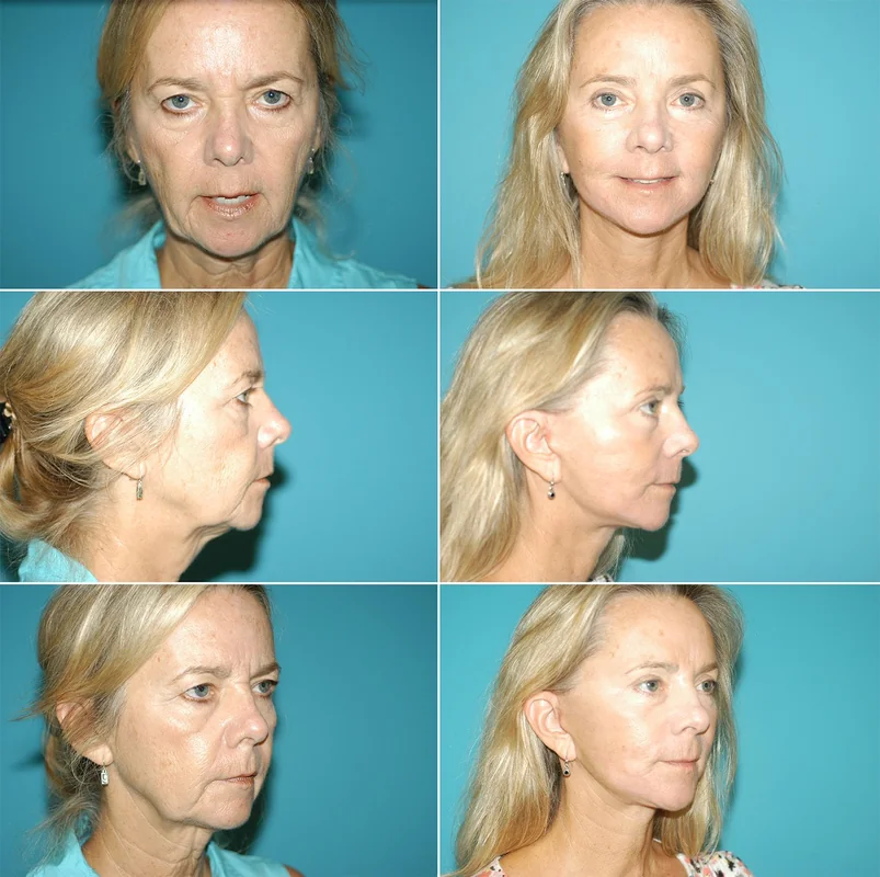 Face lift before and after showcasing jawline and cheek rejuvenation.