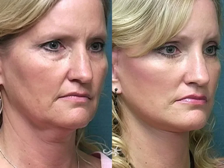 Face lift before and after with smoother skin and reduced sagging.